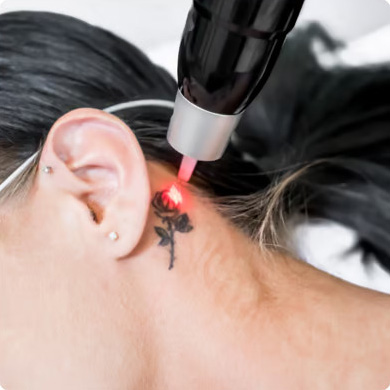 Tattoo Removal Borivali
